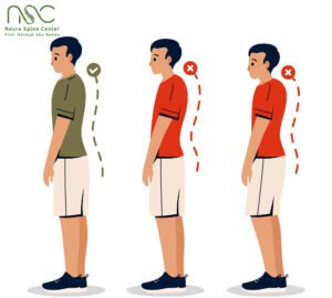 تقوس العمود الفقري