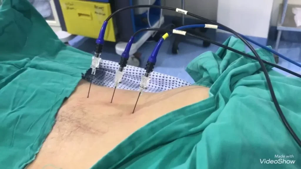 حقن جذور الاعصاب