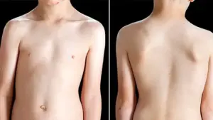 اضرار انحناء العمود الفقري